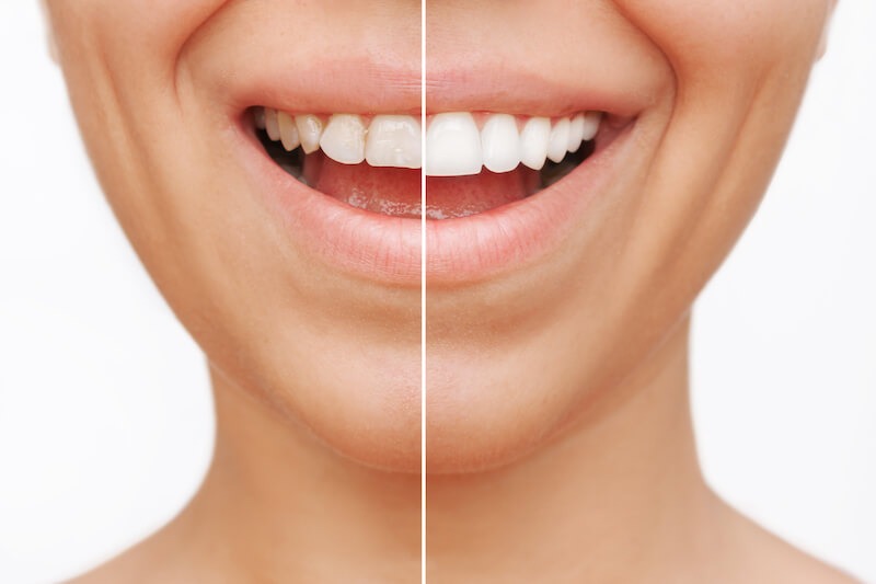 before and after veneers round rock clearview dental